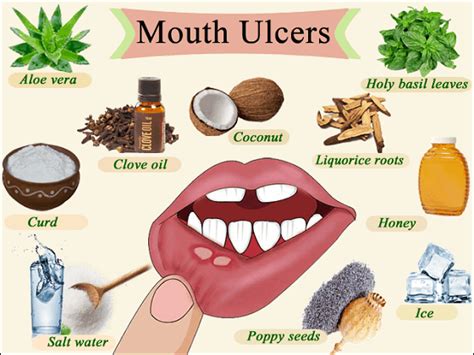 Mouth Ulcers Types Causes Symptoms And Treatments