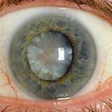 Pictures of Cataract Surgery Recovery Driving