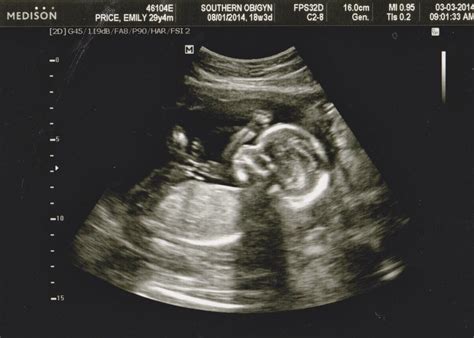 17 Weeks Pregnant Baby Moving Ultrasound Ababyw