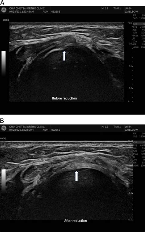 A Sonographic Image Of The Left Side Of A Nursemaids Elbow In A Boy