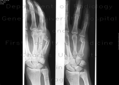 Radiology Case Subcapital Fracture Of The Fifth Metacarpal Boxers