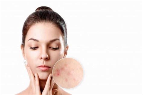 Do you have breakouts on your body that refuse to go in spite of following a good skincare routine? 13 Skincare untuk Fungal Acne Paling Efektif - DokterSehat