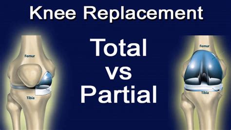 the difference between total knee replacement and partial knee replacement youtube