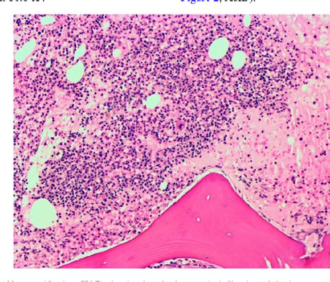 Figure 1 From Severe Thrombocytopenia In A Splenectomized Patient With