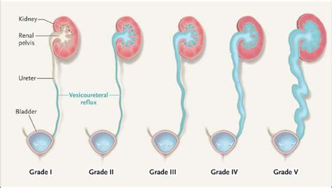 international classification of vesicoureteral reflux this download scientific diagram