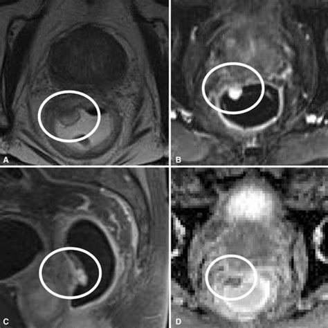 Surgically Proven Rectal Carcinoid A Axial T2 Weighted Fat Saturated