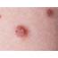 What Are Skin Tags And They Dangerous  First For Women