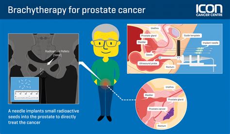Focal Brachytherapy For Prostate Cancer Icon Cancer Centre