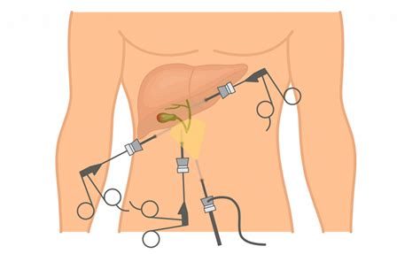 Laparoscopic Cholecystectomy Benefits Contraindications Procedure
