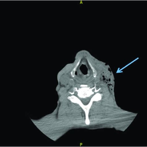 Ct Soft Tissue Neck Wo Contrast Showing Left Sided Soft Tissue