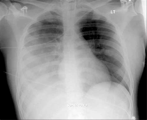 Chest X Ray On Admission To ICU Showing Right Consolidation And