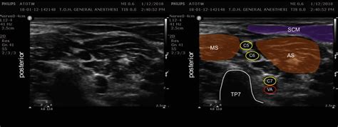 Ultrasound Guided Interscalene Brachial Plexus Block Porn Sex Picture