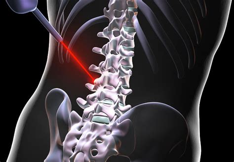 Can Laser Spine Surgery Fix Your Back Pain Health Essentials From