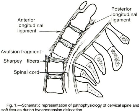 Pdf Hyperextension Dislocation Of The Cervical Spine Semantic Scholar