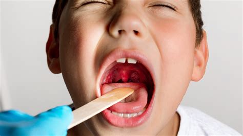 Tonsillitis Explained Causes Symptoms And Treatments