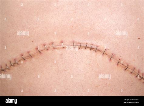 Abdominal Incision Hi Res Stock Photography And Images Alamy