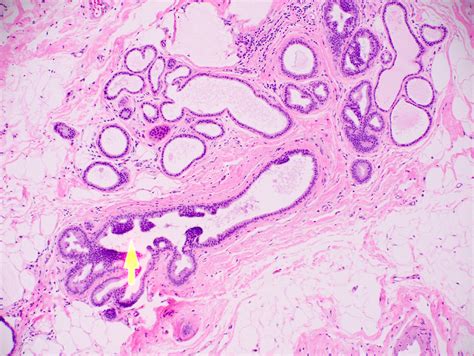 Pathology Outlines Atypical Ductal Hyperplasia