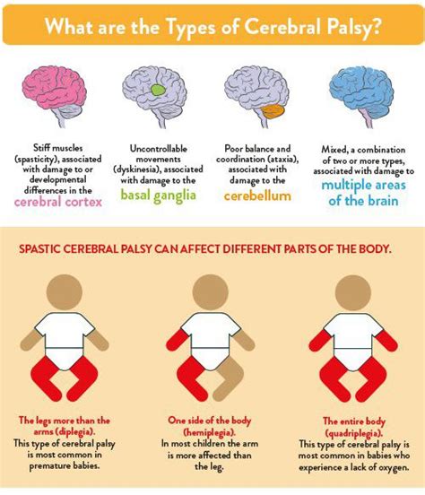 Types Of Cerebral Palsy Artofit