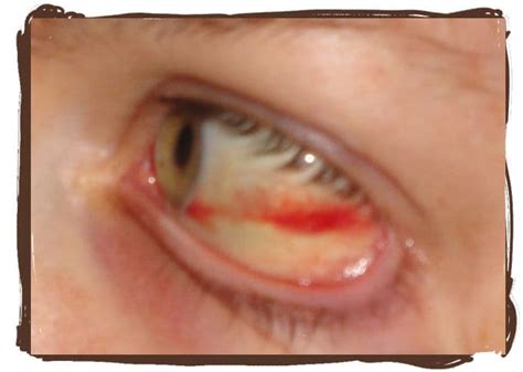 Why Did My Eye Turn Red Subconjuctival Hemorrhage Patient S Lounge