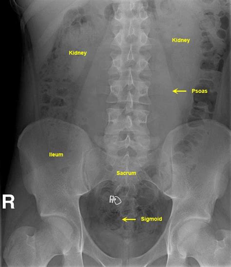 Abdominal X Ray Interpretation Plain Abdomen Radiography Medical