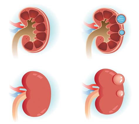 Kidney Cyst General Information Cystic Kidney Disease Classification