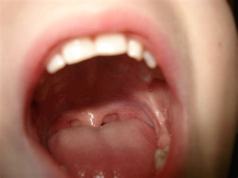Mandelentzündung Angina Tonsillaris Tonsillitis Gesundmed