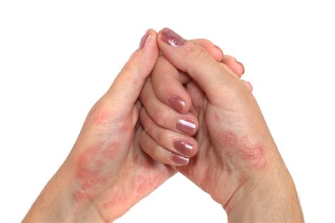 Contact Dermatitis Frequently Associated With Psoriasis Atopic