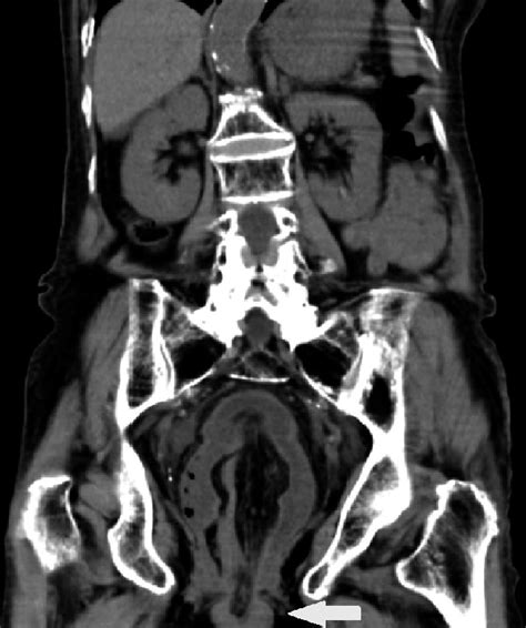 Coronal Section Of Ct Scan Showed Intussusception Headed By The Tumor