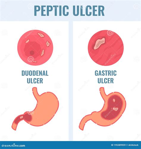 Tipos Duodenales Y Gástricos De úlcera Péptica Enfermedad Estomacal Ilustración del Vector