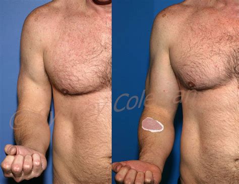 Treatment Of Biceps Muscle Tear With Coleman Fat Grafting