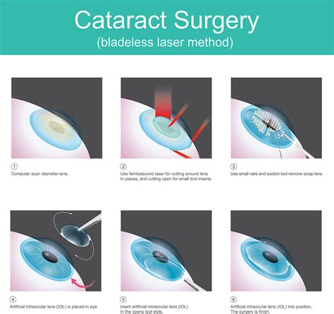 Cataract Azar Eye Clinic