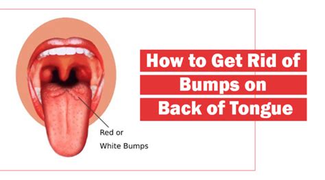 What Are Bumps On Back Of Tongue And How To Get Rid Of Them