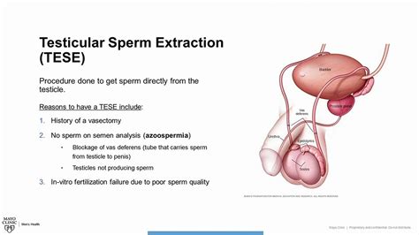 Testicular Sperm Extraction Tese Procedure Overview คำแนะนำ ความ