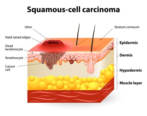 Squamous Cell Carcinoma Scc Cbd Skin Cancer Clinic