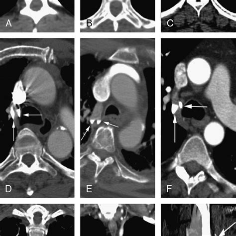 Chest Ct Scans Performed Either As Whole Body Ctas Or Ctpas Windowing