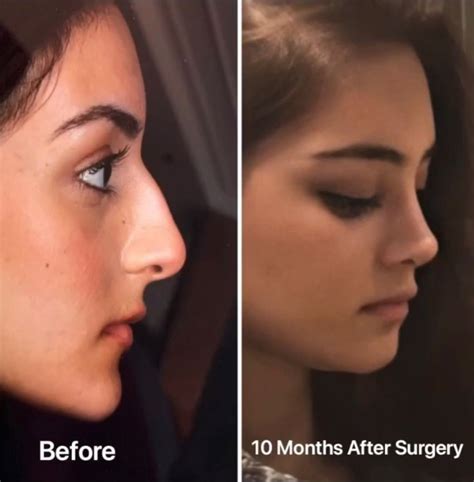 Pin By Medipars On Rhinoplasty Before After Nose Job Nose Plastic Surgery Perfect Nose
