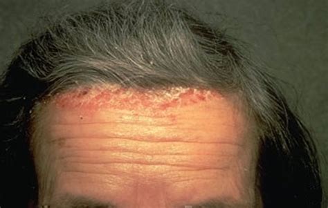 Scalp Psoriasis Causes Andtreatment Options Natural And Home Remedies