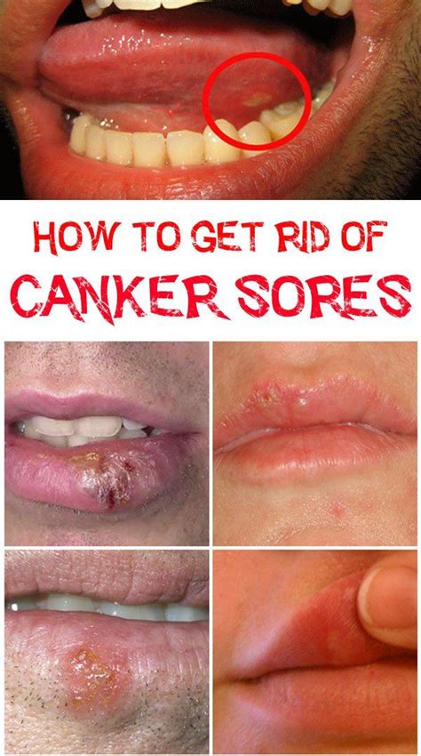 How To Get Rid Of Canker Sores On Tongue Canker Sore