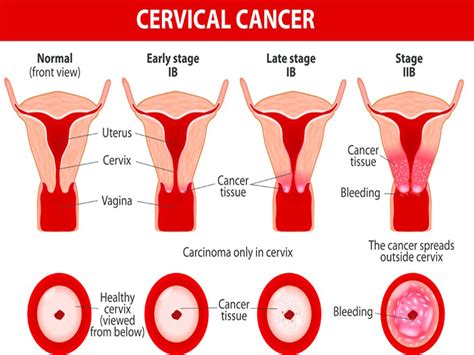 Cervical Cancer Symptoms And Causes Styles At Life