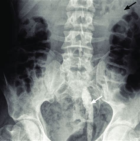 Plain Film Radiography Showing A Long Stick Shaped Vertical