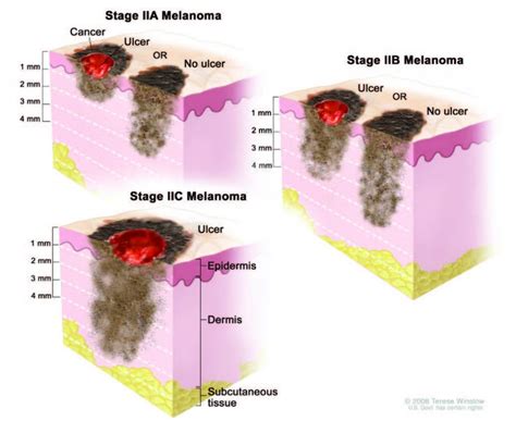 Melanoma Stages Stages Of Melanoma In Situ Stage 0 To Iv Advanced