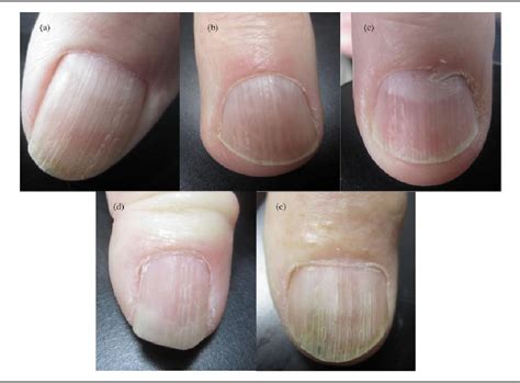 Psoriatic Nail Changes Are Associated With Clinical Outcomes In