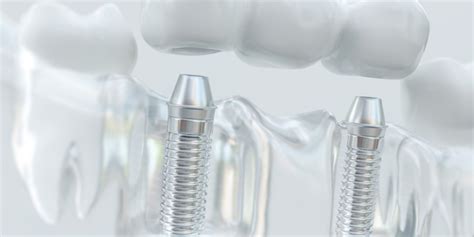 Dental Implant Asli Tarcan Dental Clinic Turkey