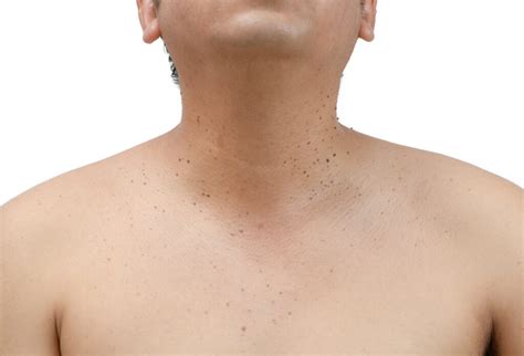 Seborrheic Keratosis 152 Harley Street