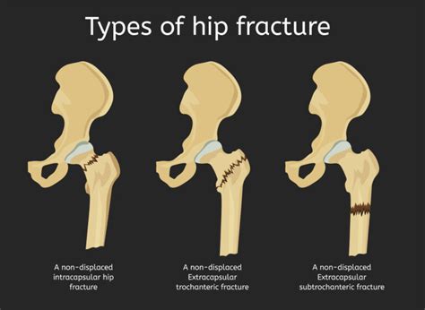 Hip Fractures Types Symptoms Treatment And Surgery Zealmax