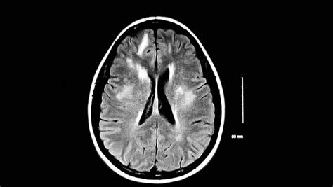 An Abnormal Mri Of The Brain Showing Sclerotic Lesions Usually