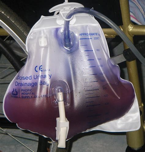 Purple urine bag syndrome (pubs) is a complication of urinary tract infections (utis) where catheter bags and tubing turn purple. Purple Urine Bag Syndrome | Medical Laboratories