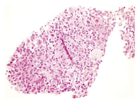 The Core Biopsy Shows The Aggregation Of Histiocyte Like Cells Some Of