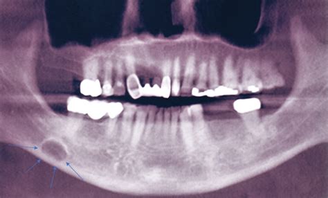 Inferior Border Of Mandible