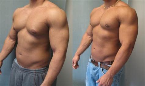 Dr Mordcai Blau Gynecomastia Surgeon In New York And New Jersey